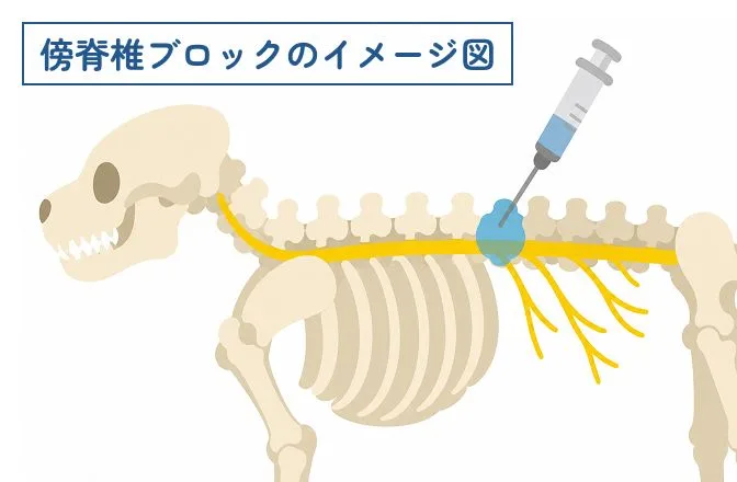傍脊椎ブロックのイメージ図