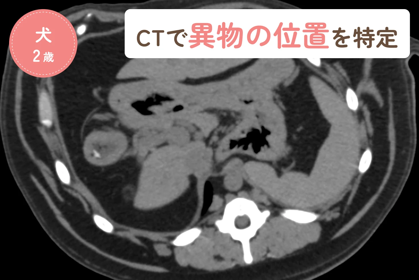 CT検査で異物の位置を正確に把握｜腸閉塞に対して緊急手術を行った症例のアイキャッチ画像