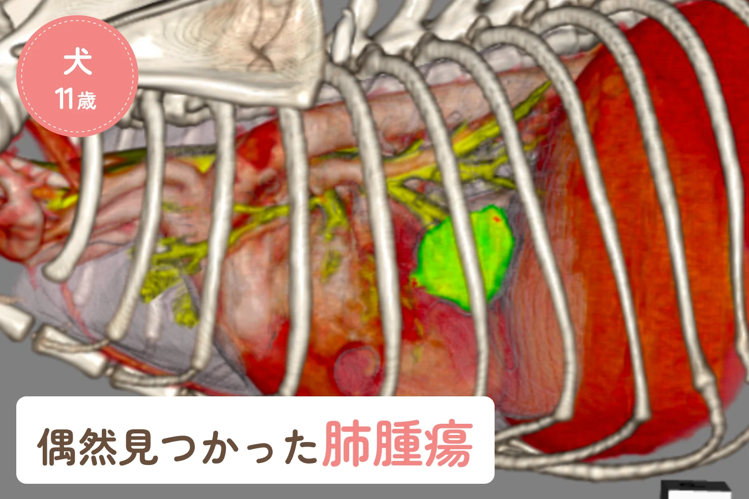 偶然見つかった肺腫瘍｜CT検査が診断と手術につながった症例のアイキャッチ画像